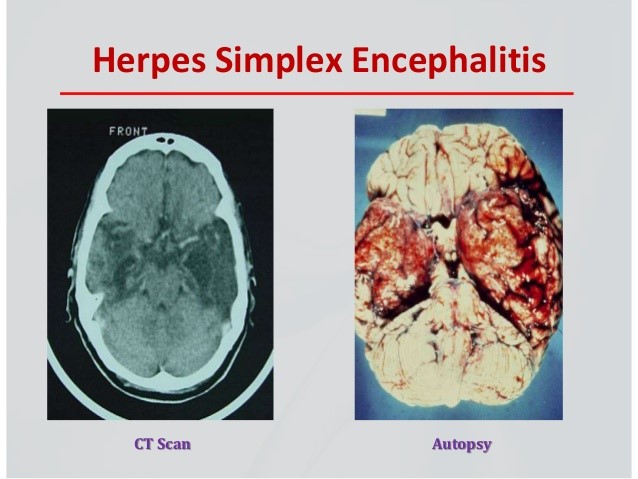 Ảnh 2 của Viêm não Herpes